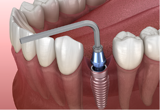 어버트먼트 식립
