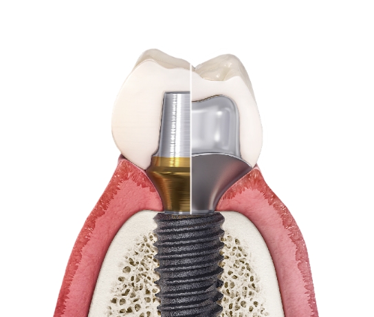 맞춤형 어버트먼트 설명