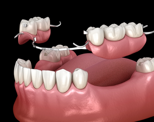 부분틀니 이미지