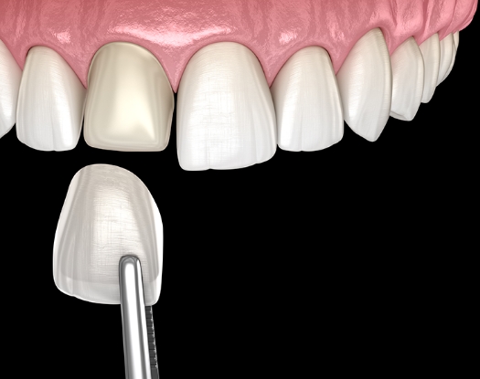 라미네이트 이미지